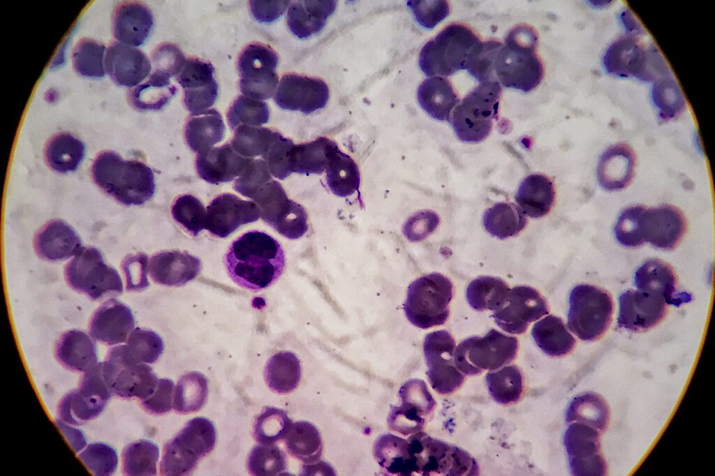 leukemia under the microscope