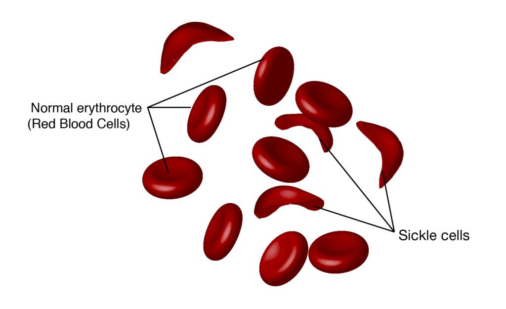 what blood cells look like with sickle cell disease (SCD)