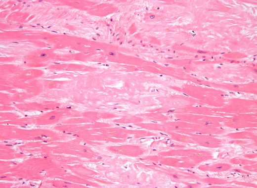 Cardiac_amyloidosis_high_mag_he wikimedia commons amyloidosis