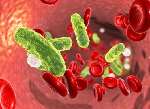 sepsis