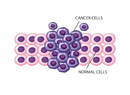 triple-negative-breast-cancer